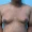 Gynecomastia Correction